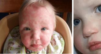 शिशु में एलर्जी के लक्षण और उनका इलाज कैसे करें शिशुओं में खुजली वाली त्वचा में क्या मदद करता है