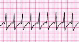Ventrikulārās aritmijas un pēkšņas sirds nāves profilakse Vadīšanas traucējumu klīniskās prakses vadlīnijas