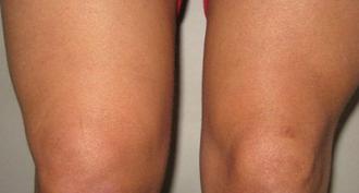Развитие коленной чашечки, травмы и их последствия Четыре главных симптома